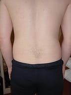 Back Pain