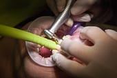  Teeth Replacement