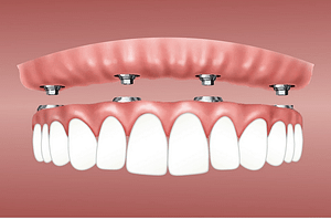 teeth implants