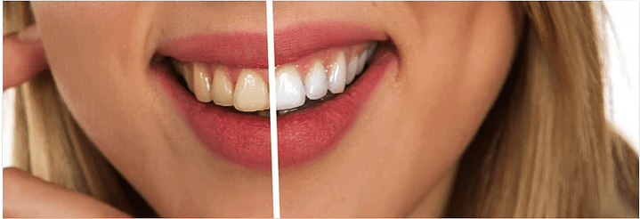 teeth whitening